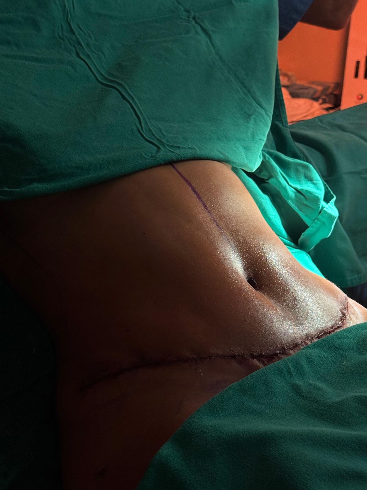 Abdominoplastia