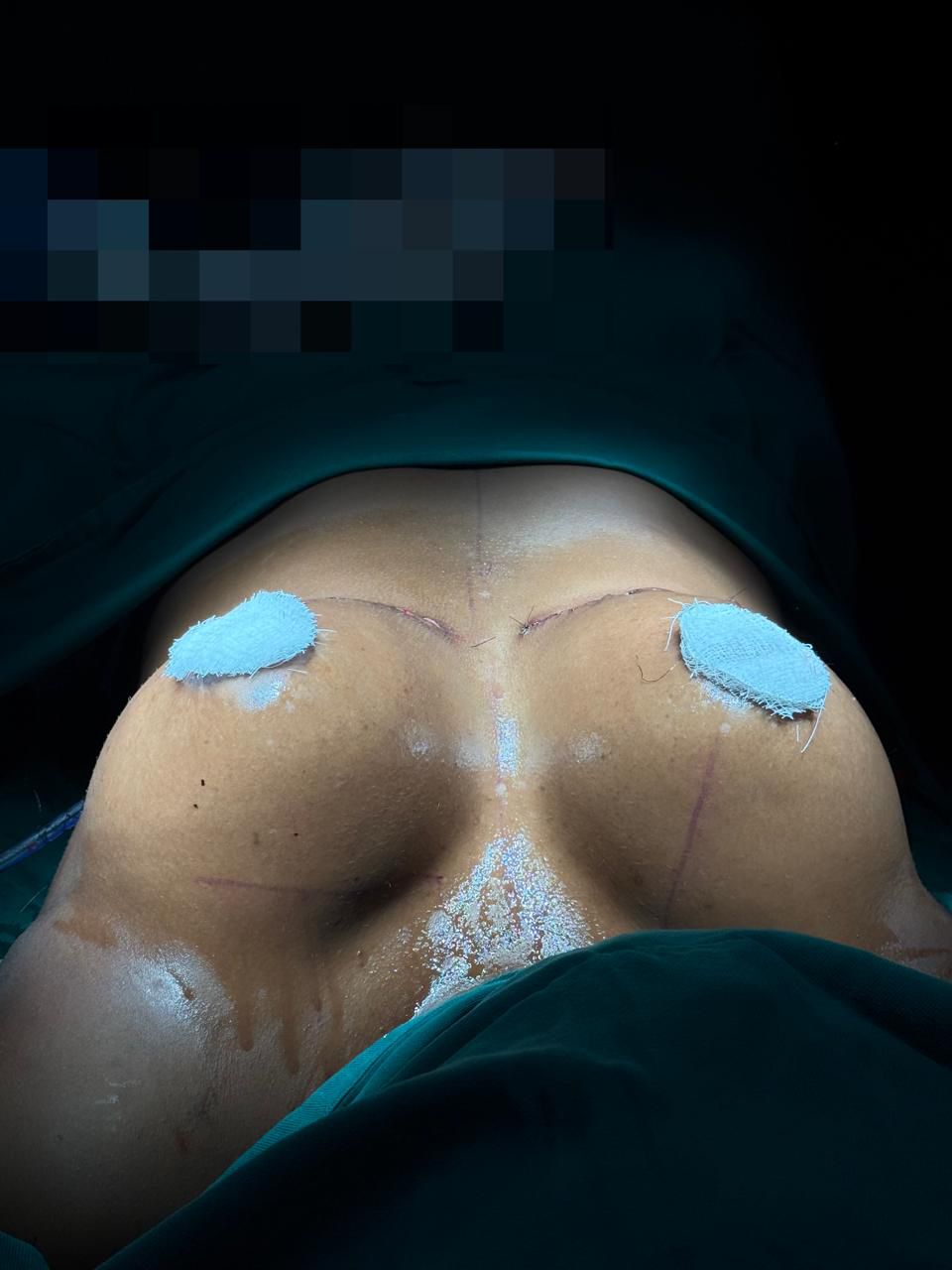 Mamoplastia
sem Prótese